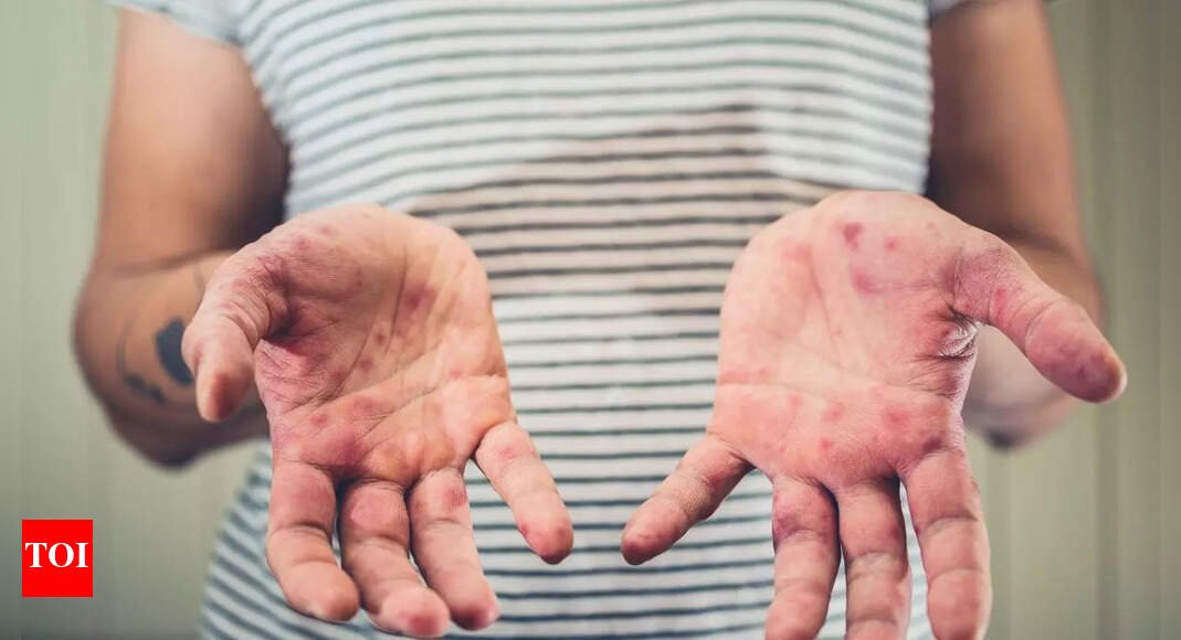 measles-claims-young-life-in-liverpool:-what-are-the-symptoms-of-the-infection-and-how-it-spreads
