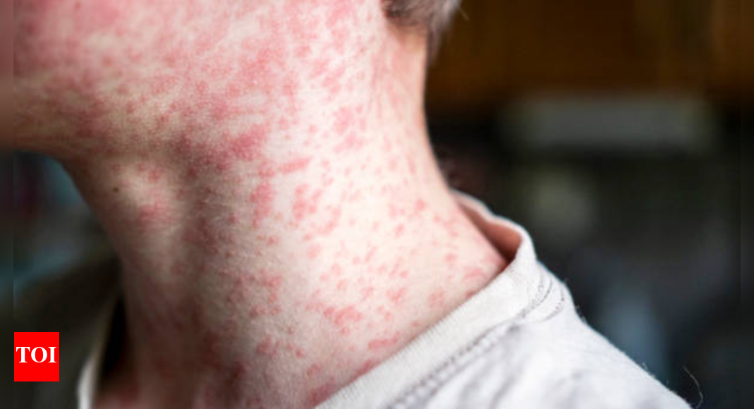 measles-and-travel:-countries-with-measles-outbreaks-in-2025-(travel-alerts-and-safety-tips)