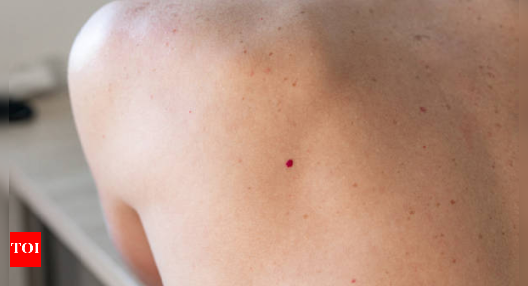 cherry-angiomas:-are-those-red-bumps-on-your-skin-linked-to-cancer-or-liver-diseases?