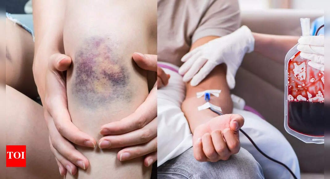 blood-cancer-symptoms:-unexplained-bruising-and-shoulder-pain-could-be-a-sign-of-serious-health-risk