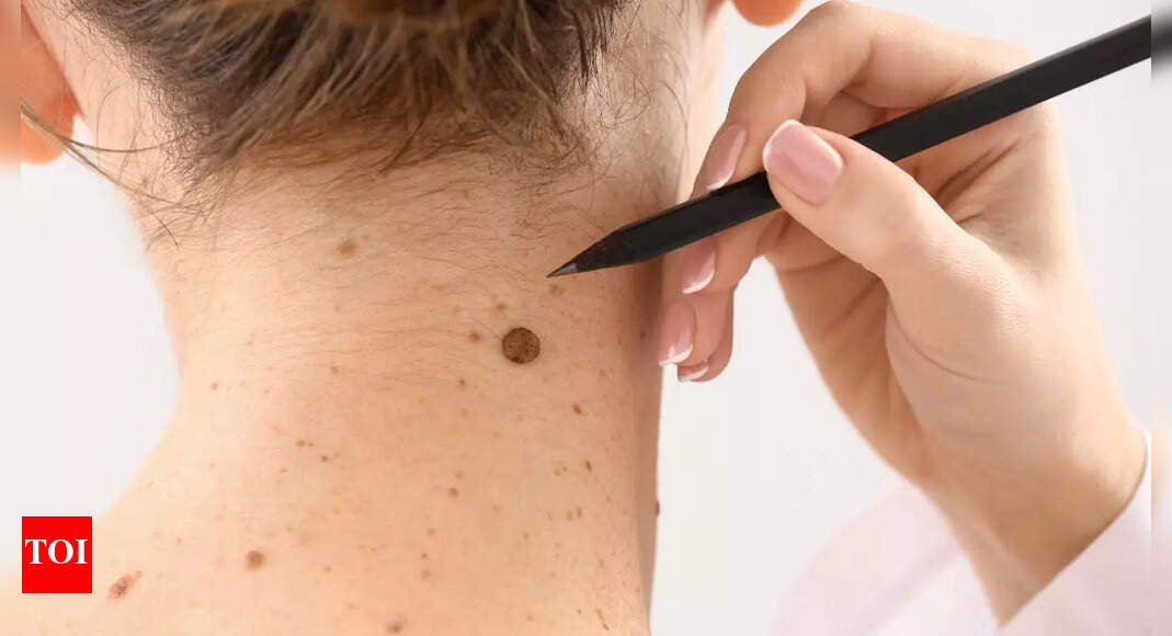 6-early-melanoma-signs-that-reveal-hidden-skin-cancer-risks