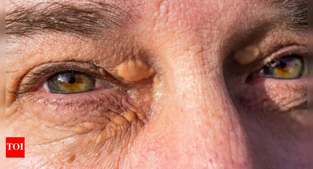 high-cholesterol-signs-that-appear-on-your-skin-before-a-heat-test