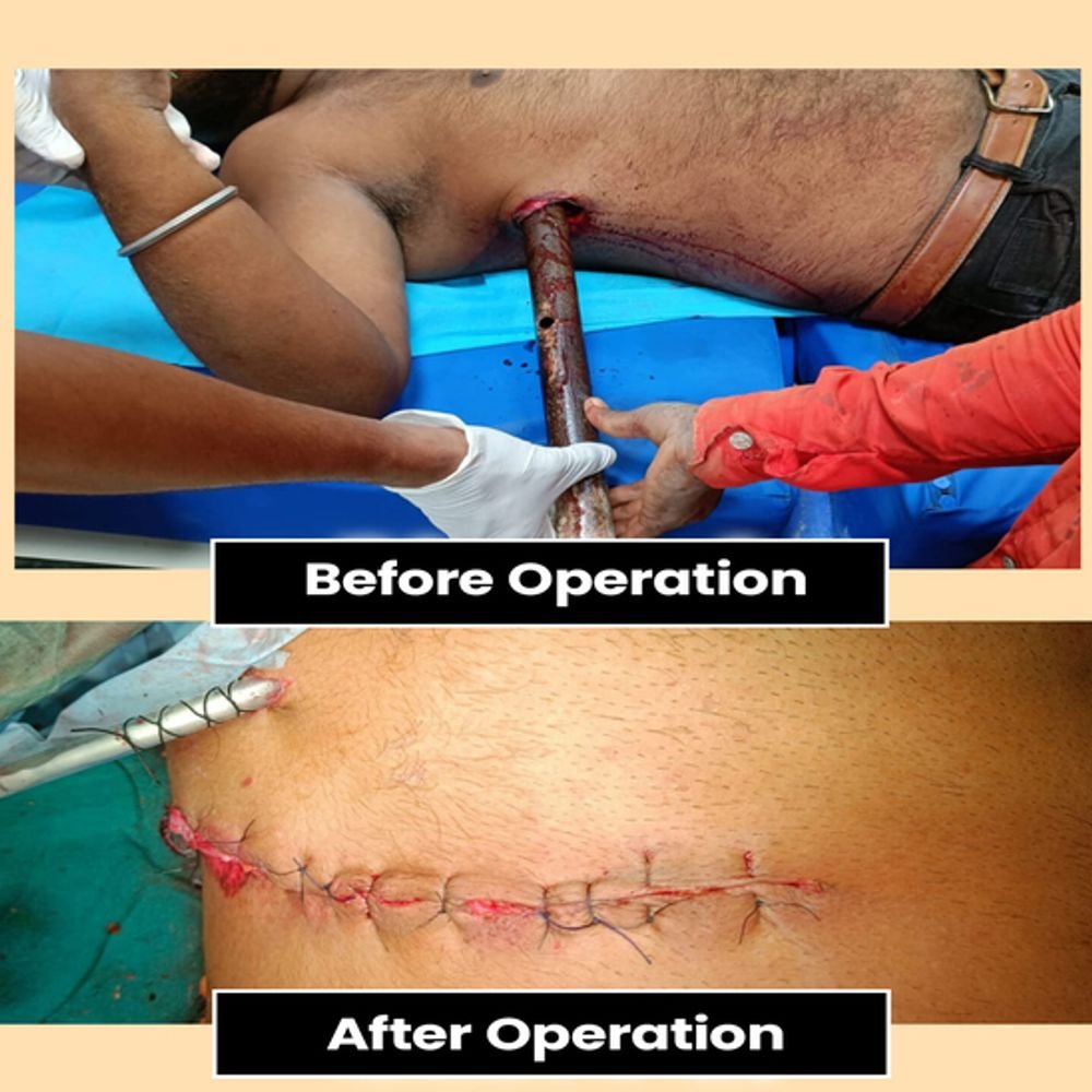 aiims-bhopal-gives-new-lease-of-life-to-construction-worker:metal-rod-pierced-through-latter’s-chest-in-harda;-doctors-perform-90-minute-surgery-on-him
