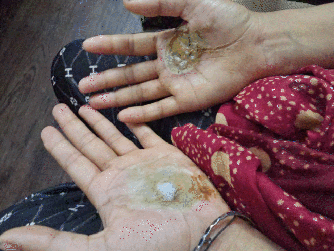 palms-burnt,-hot-coin-pressed-on-forehead:woman-tortured-for-‘exorcising-evil-spirits’-in-ujjain;-8-booked