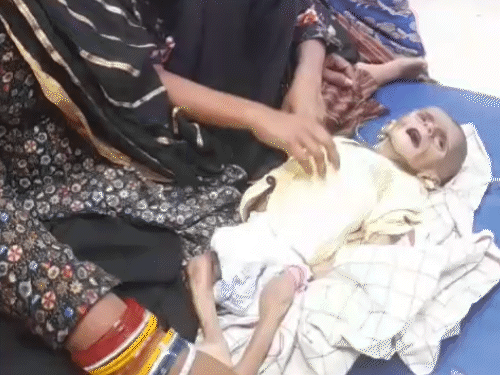 4-month-old-baby’s-skin-stuck-to-bones:weighs-only-2.5-kg-due-to-malnutrition,-admitted-to-satna-district-hospital-picu