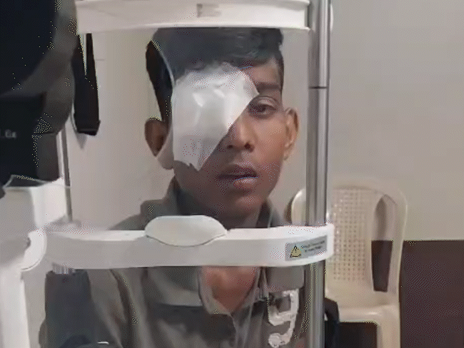 explosive-carbide-guns-used-to-scare-monkeys-cause-eye-injuries:icmr-issued-warning-in-2023;-300-people-suffered-eye-burns-in-mp-so-far