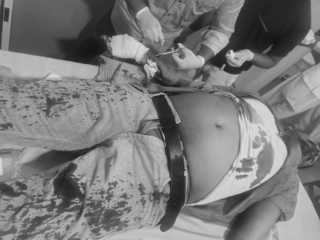 betul-youth’s-hand-severed-in-marriage-dispute:masked-attacker-targets-couple;-accused-planning-to-go-abroad,-traced-through-phonepe-transaction