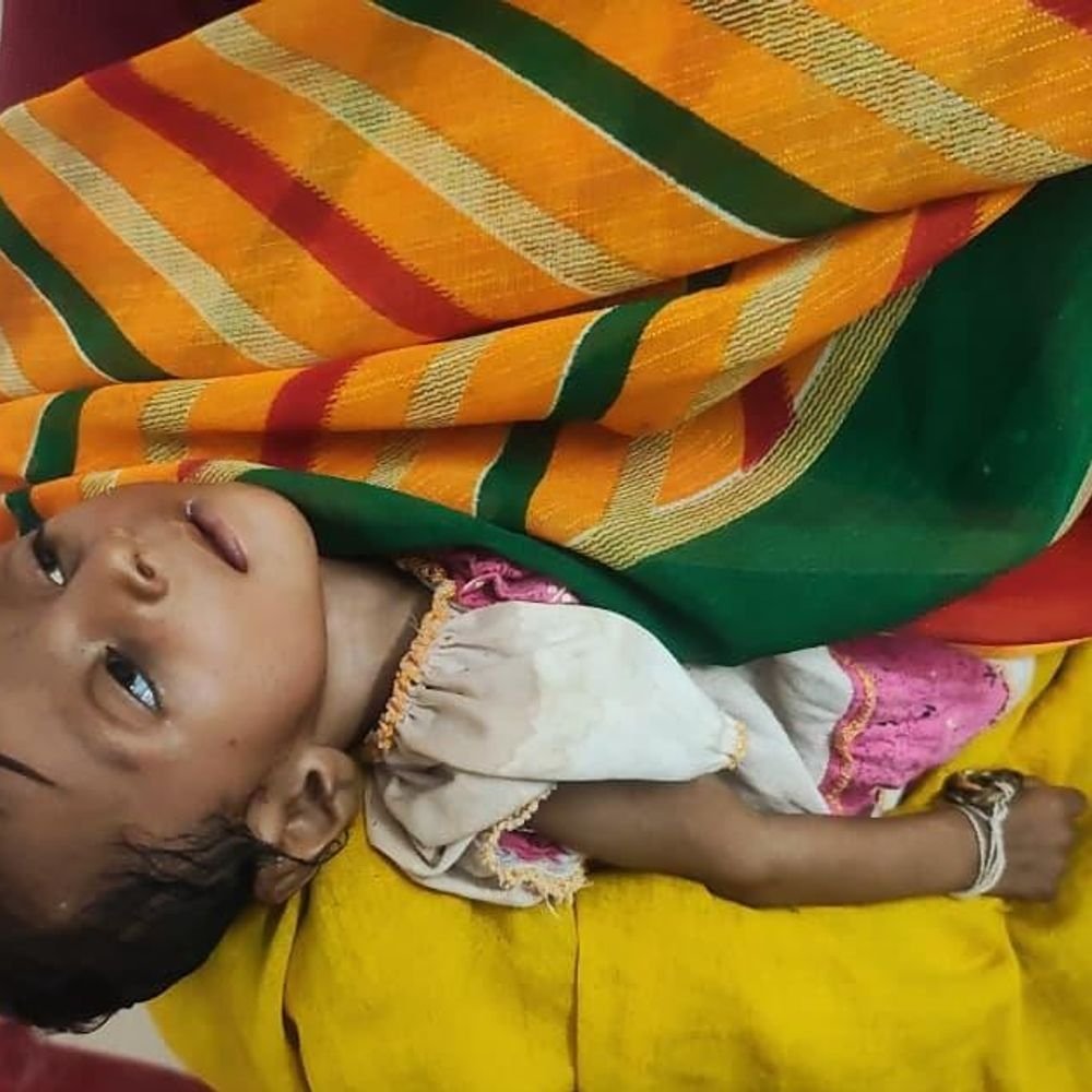 infant-dies-of-malnutrition,-7-officials-served-notices:cmho-questions-negligence,-seeks-explanation;-delayed-screening-blamed-for-death