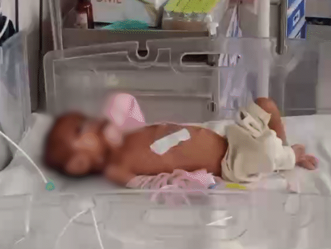 5-month-old-malnourished-baby-girl-found-in-mp:underweight-infant-with-one-ear-missing;-doctors-cite-uncontrolled-sugar,-referred-to-rewa