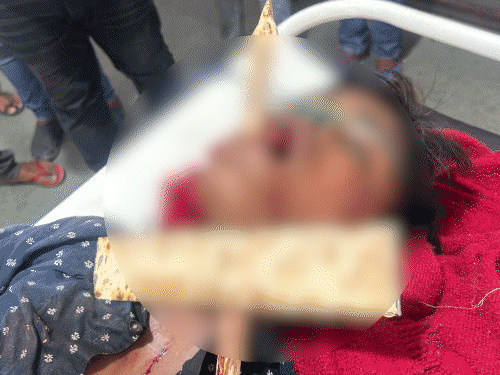 iron-rod-pierces-teen’s-jaw-in-khargone:17-year-old-rushed-to-indore-with-rod-sticking-through-mouth