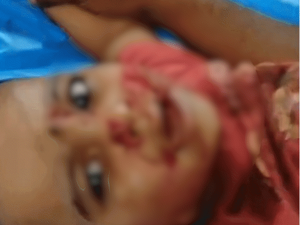 stray-dog-mauls-toddler’s-face-in-shivpuri:lip-split-into-two,-child’s-scalp-torn-off,-65-people-attacked-in-a-day