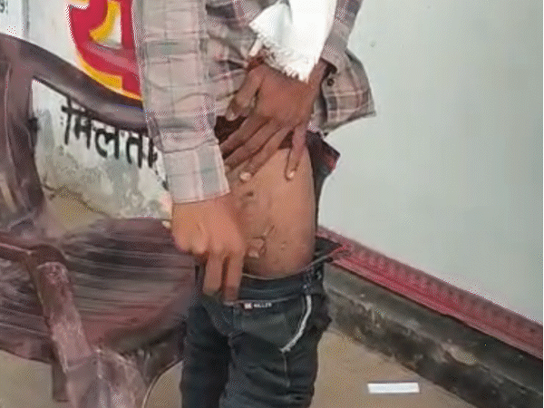 redmi-phone-explodes-in-rider’s-pocket-on-moving-scooter:clothes-catch-fire,-leg-burnt,-skin-peeled-off-in-panna